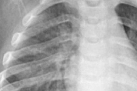 Deteksi cepat Chlamydia pneumoniae: andal dan efisien